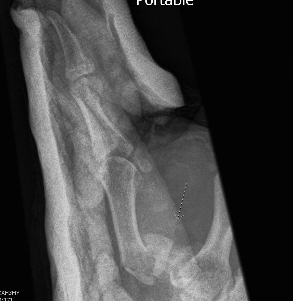 Bennetts Fracture AP